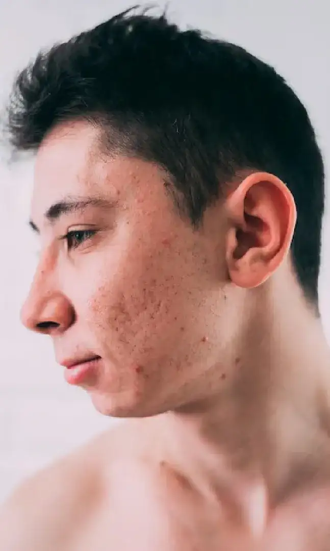 ¿Cómo eliminar el acné?