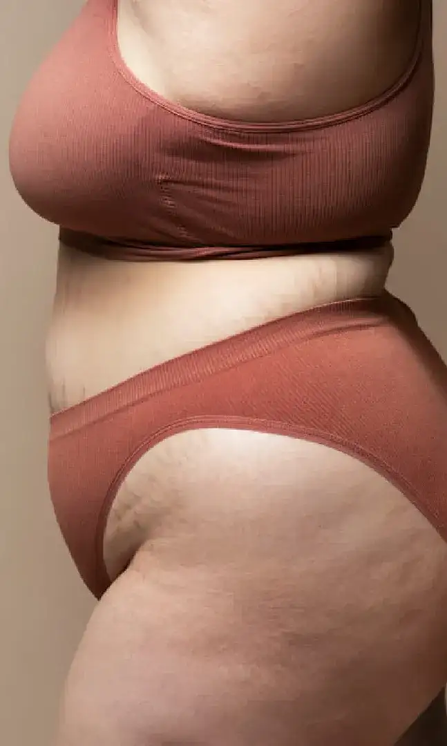 lipedema solución