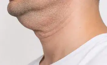 papada con ligera flacidez