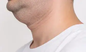 papada estructural o genética