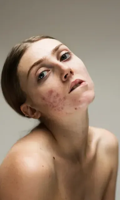 tratamiento anti acne